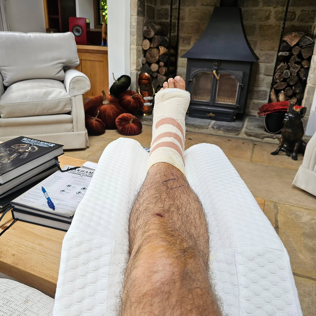 Генри Кавилл показал фото восстановления травмированной в ходе съёмок «Горца» ноги - изображение 1 Генри Кавилл показал фото восстановления травмированной в ходе съёмок «Горца» ноги - фото 1