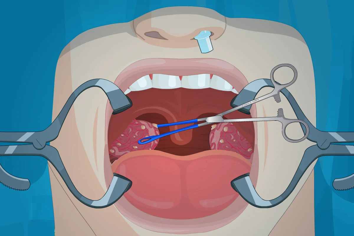 Operate Now: Tonsil Surgery - кадр 3